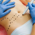 Chirurgia Plastica Intervento Mastoplastica Roma